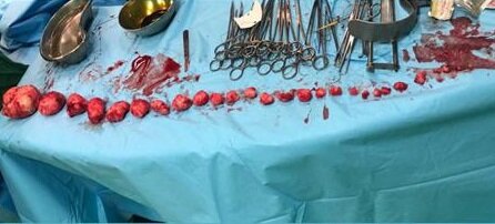 خارج کردن ۲۷ توده از رحم دختر ۳۹ ساله بندرعباسی 