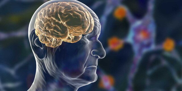 برخی اشکال پروتئینها بیانگر ابتلا به بیماری پارکینسون است