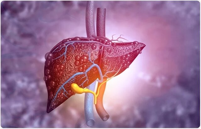توسعه ترکیب ایمنی‌ درمانی جدید برای سرطان کبد