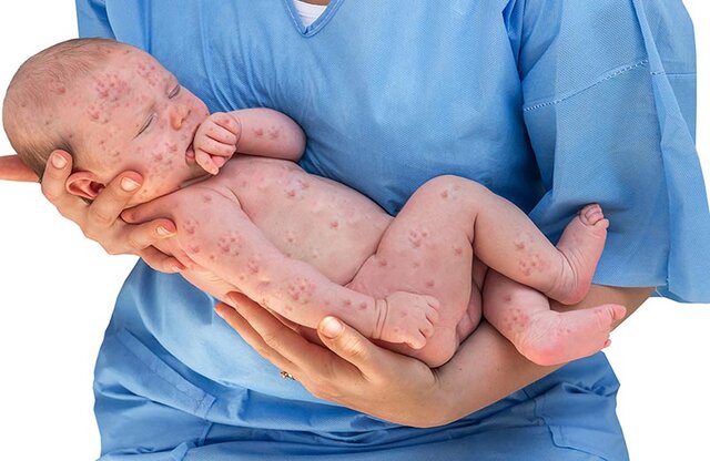 احتمال نقص نوزادان متولد شده از مادران مبتلا به سرخجه