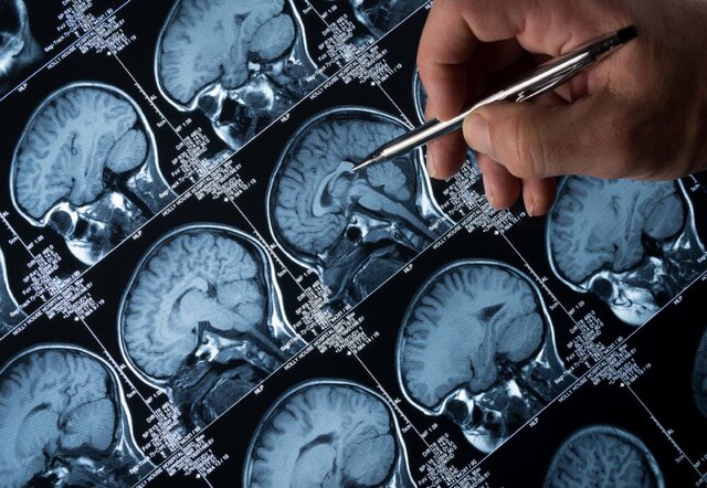 پیشبینی ابتلا به زوال عقل ۱۵ سال قبل