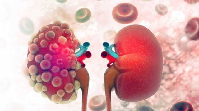 کشف روشهای درمانی بالقوه بیماری کلیه پلیکیستیک