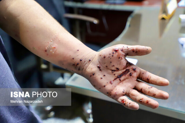 عکس تزئینی است سوختگی نوجوان ۱۶ ساله در استان کرمان به دلیل انفجار نارنجک دستی