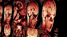 همپوشانی عصبی در بی‌خوابی، افسردگی و اضطراب وجود دارد؟