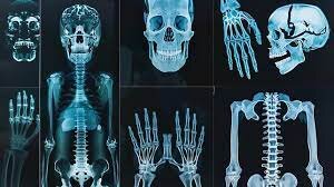 احیا طبیعی استخوان میسر شد