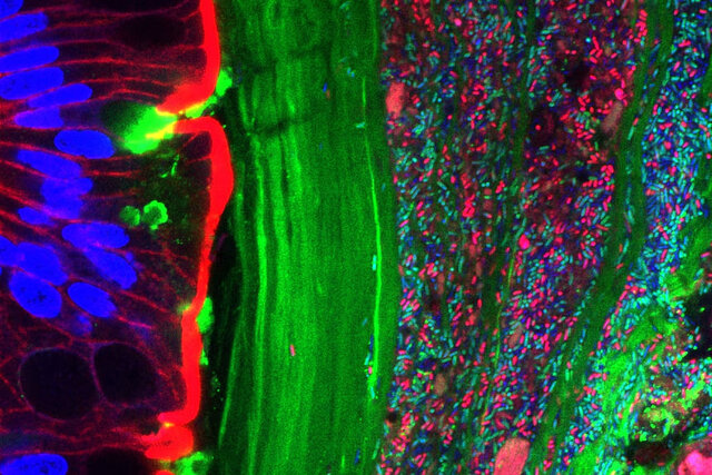 باکتریهای روده با سنگ کلیه مقابله میکنند