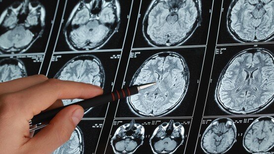 پیشگیری از آلزایمر از امروز آغاز میشود، نه بعد از ۶۵ سالگی پیشگیری از آلزایمر از امروز آغاز میشود، نه بعد از ۶۵ سالگی