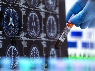 تشخیص بیماری آلزایمر با کمک هوش مصنوعی