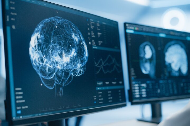 آزمایش رایگان شناسایی آلزایمر با کمک هوش مصنوعی