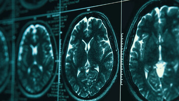 روشی در توقف بیماری آلزایمر کشف شد