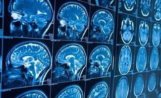 روشی در توقف بیماری آلزایمر کشف شد