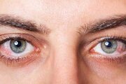 دیابت، شایع‌ترین علت قابل پیشگیری کوری