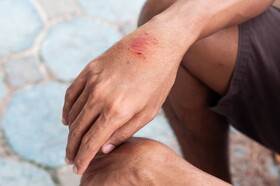 هاری؛ از پیشگیری تا مرگ