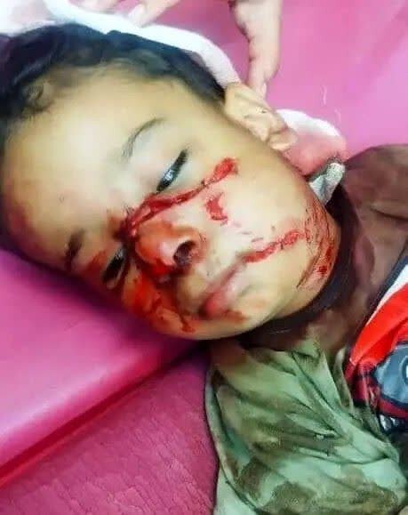 حمله سگهای بلاصاحب به کودک ۴ ساله در شوش