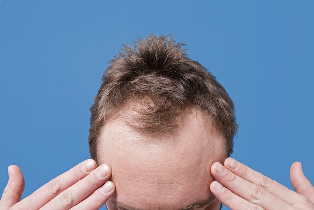 کدام ریزش مو در مردان شایع‌تر است؟