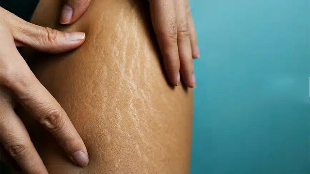 سلولیت؛ تجمع بد شکل چربیهای زیرپوستی سلولیت؛ تجمع بد شکل چربیهای زیرپوستی