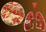 بیماریابی ۱۱۶ مورد مشکوک به سل در بیجار طی شش‌ماهه نخست سال