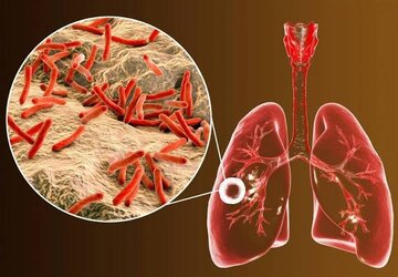 بیماریابی ۱۱۶ مورد مشکوک به سل در بیجار طی شش‌ماهه نخست سال