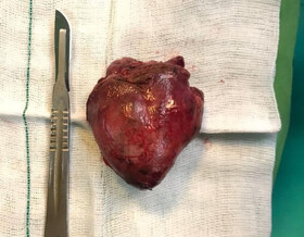 خارج کردن توده از کلیه یک بیمار در ساوه