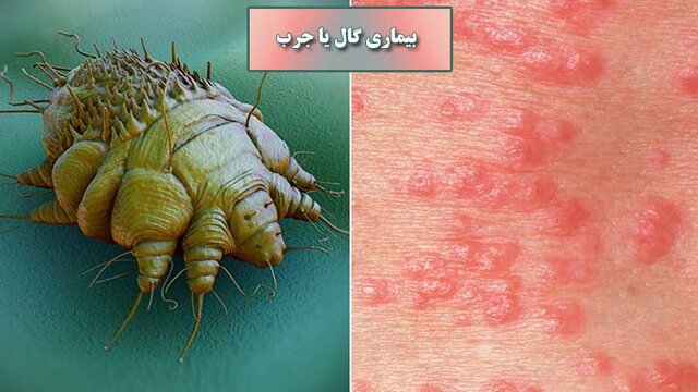 اپیدمی بیماری گال در مازندران گزارش نشده است 