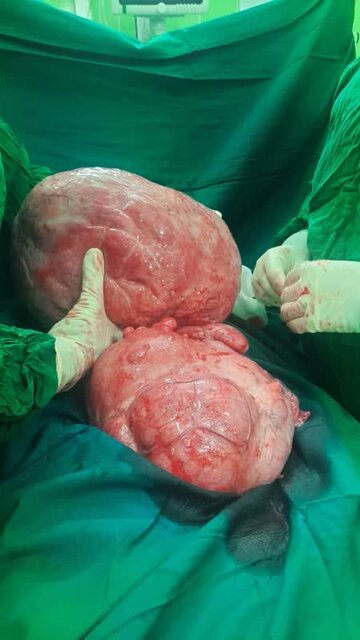 توده های شکمی ۱۰ کیلویی از شکم دوقلوهای آملی خارج شد