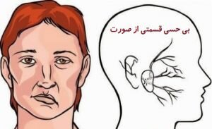 سکته مغزی ایسکمیک چیست؟ /راهکارهای پیشگیری از سکته مغزی