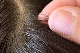 هشدار درباره شیوع شپش سر/ آلودگی به معنای رعایت نکردن بهداشت نیست