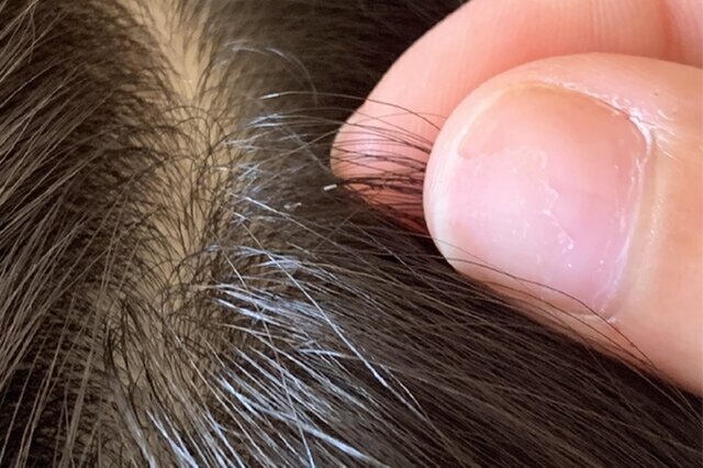 هشدار عضو هیات علمی دانشگاه علوم پزشکی بابل درباره شیوع بالای شپش در کودکان ۶ تا ۱۲ سال