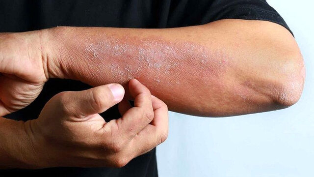 علائم عفونت و قارچ پوستی چیست؟