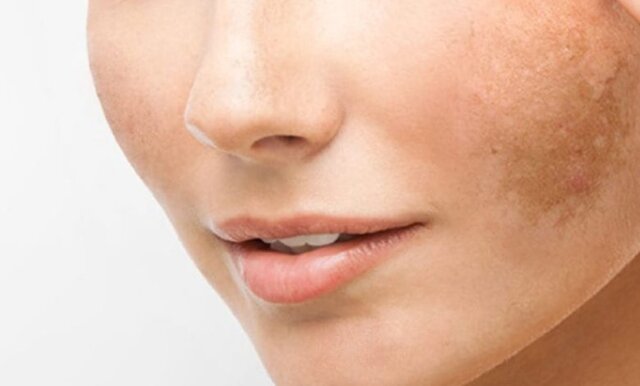 لکهای دوران بارداری چگونه از بین میروند؟