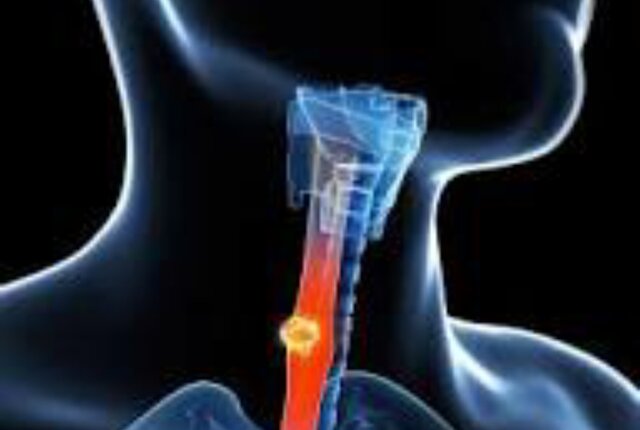 رفلاکس معده؛ علل، علائم و راهکارهای درمانی رفلاکس معده؛ علل، علائم و راهکارهای درمانی