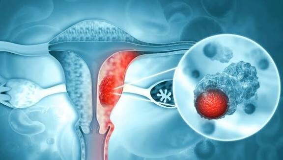 خونریزی غیرطبیعی، مهم‌ترین هشدار ابتلا به سرطان رحم