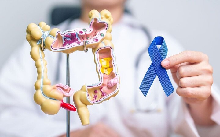 نقش ژنتیک در سرطان روده بزرگ؛ از پیشگیری تا تشخیص زودهنگام