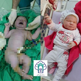 تولد نوزاد ۶ کیلو و ۲۵۰ گرمی در بیمارستان ضیایی اردکان