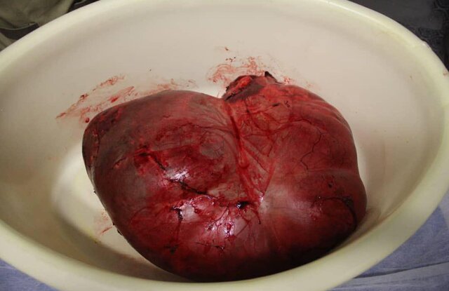 خارج کردن توده ۲۳ کیلوگرمی از بدن مرد جوان در یزد