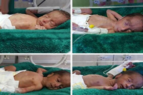 تولد نخستین ۴ قلوهای زنجانی در سال‌جاری