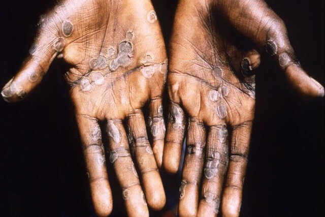 موردی از ابتلا به آبله میمونی در زنجان مشاهده نشده است