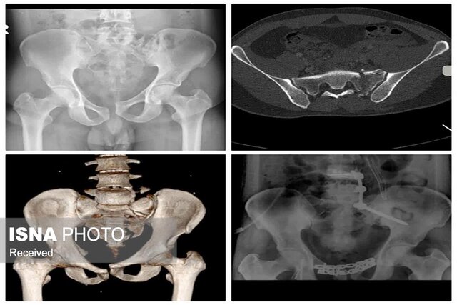 جراحی شکستگی حلقه‌های قدامی و خلفی لگن انجام شد