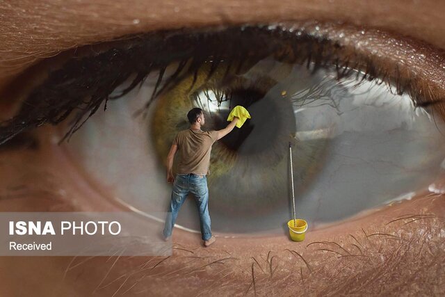 عکس تزئینی است جراحی، آب مروارید را به طور قطع درمان میکند