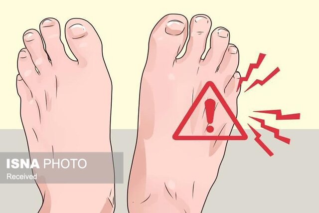 ورم یا کبودی دست و پا، علامت هشداردهنده مشکلات قلبی است ورم یا کبودی دست و پا، علامت هشداردهنده مشکلات قلبی است