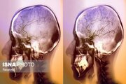 افتتاح مرکز پیشرفته آنژیوگرافی مغزی در زنجان