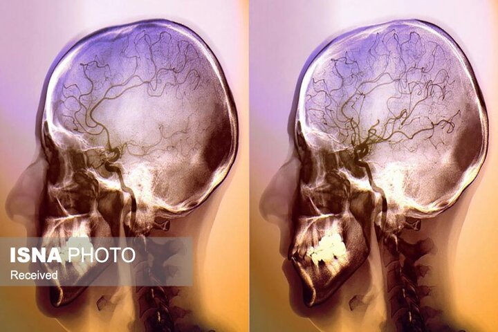 افتتاح مرکز پیشرفته آنژیوگرافی مغز در زنجان